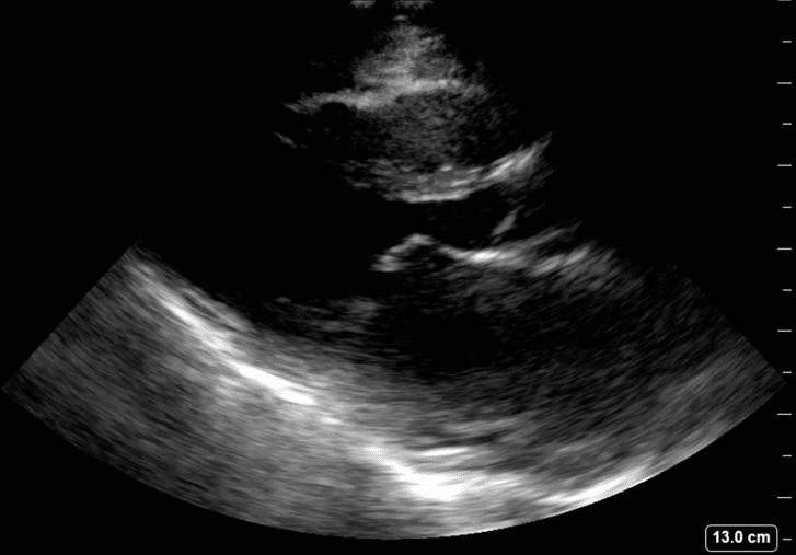 Mitral stenosis no labels