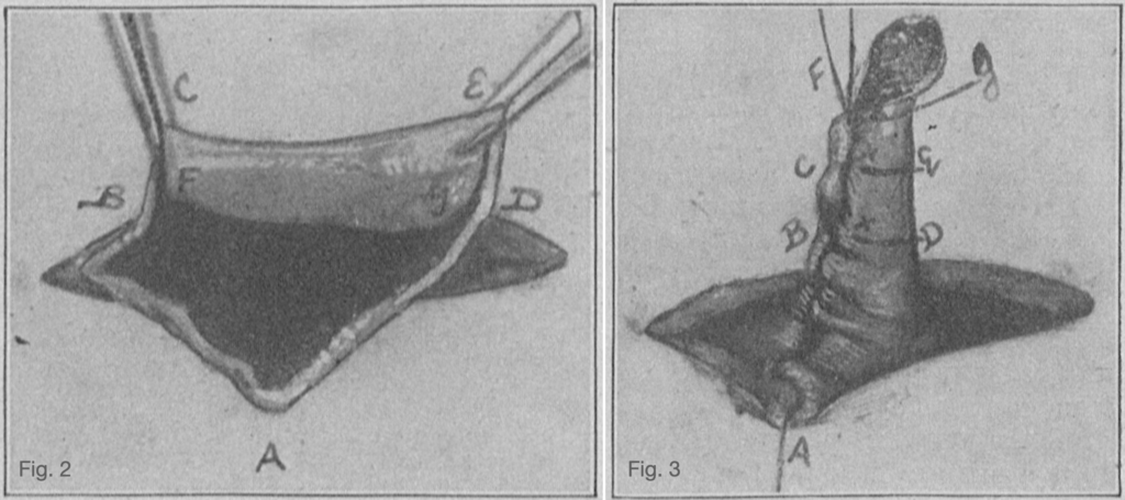 Janeway gastrostomy 1913