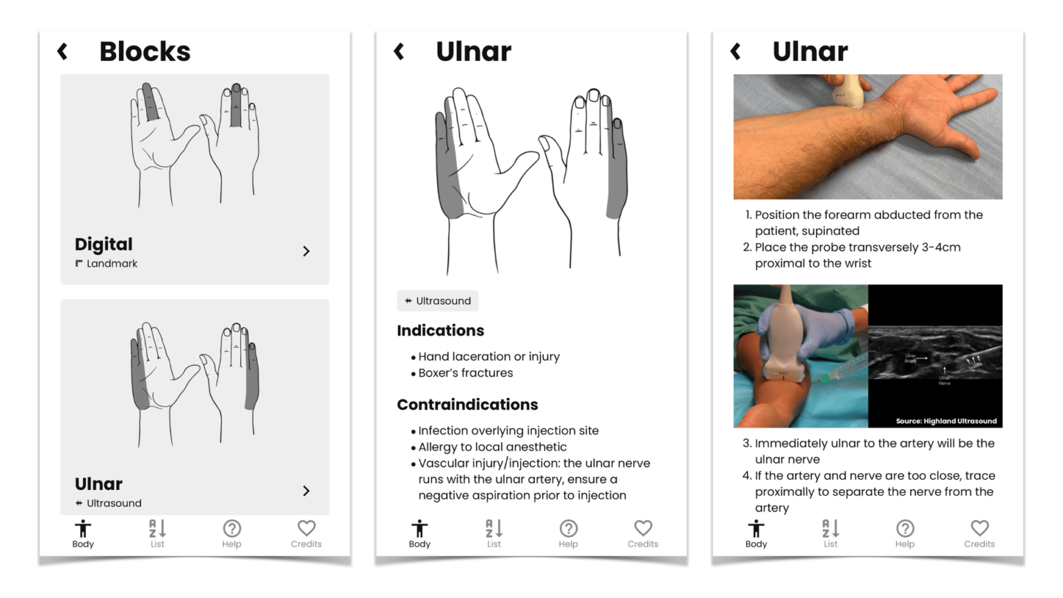 Nerve Block App • LITFL • Ultrasound Library