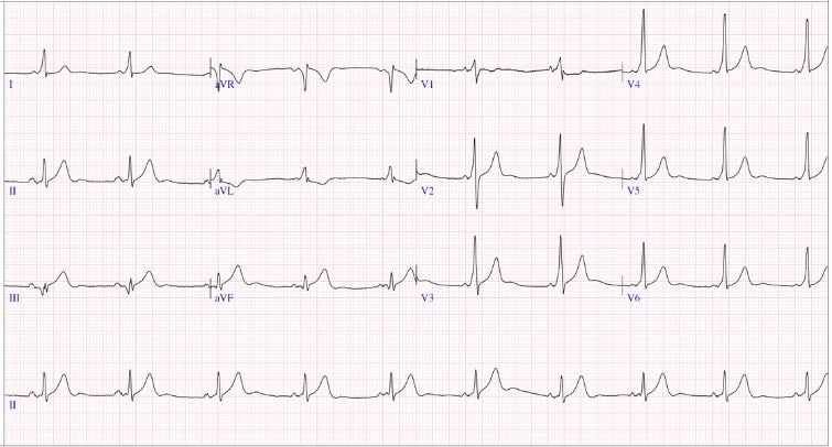 Heart HQ: WPW and Myocarditis • LITFL • Podcast