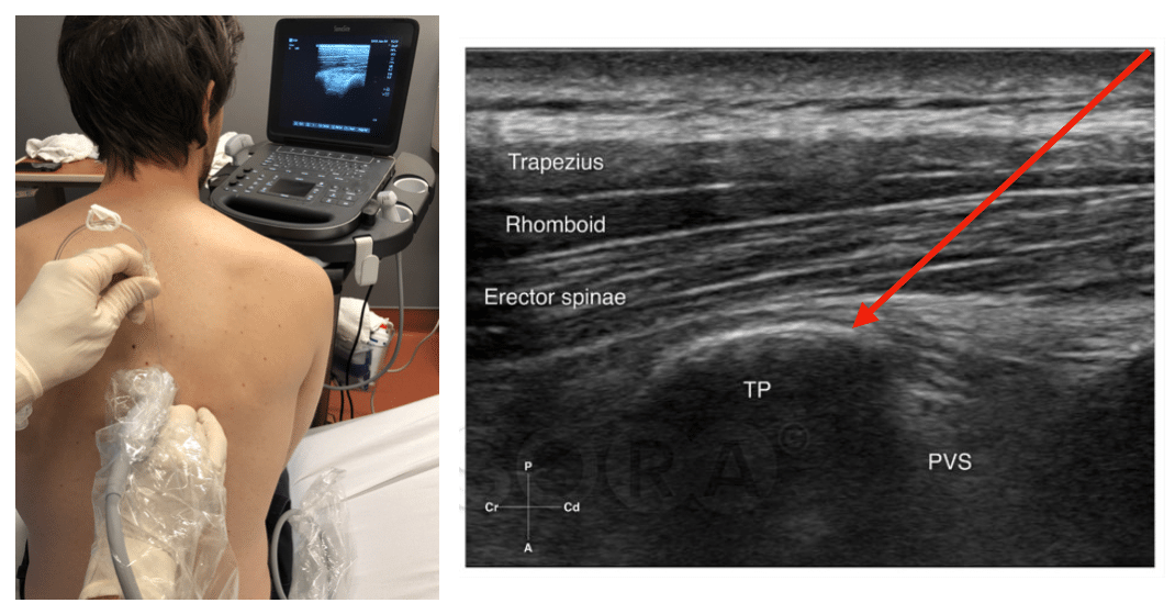 Erector Spinae Plane Block LITFL Nerve Block Library Erector Spinae Plane Block LITFL Nerve Block Library