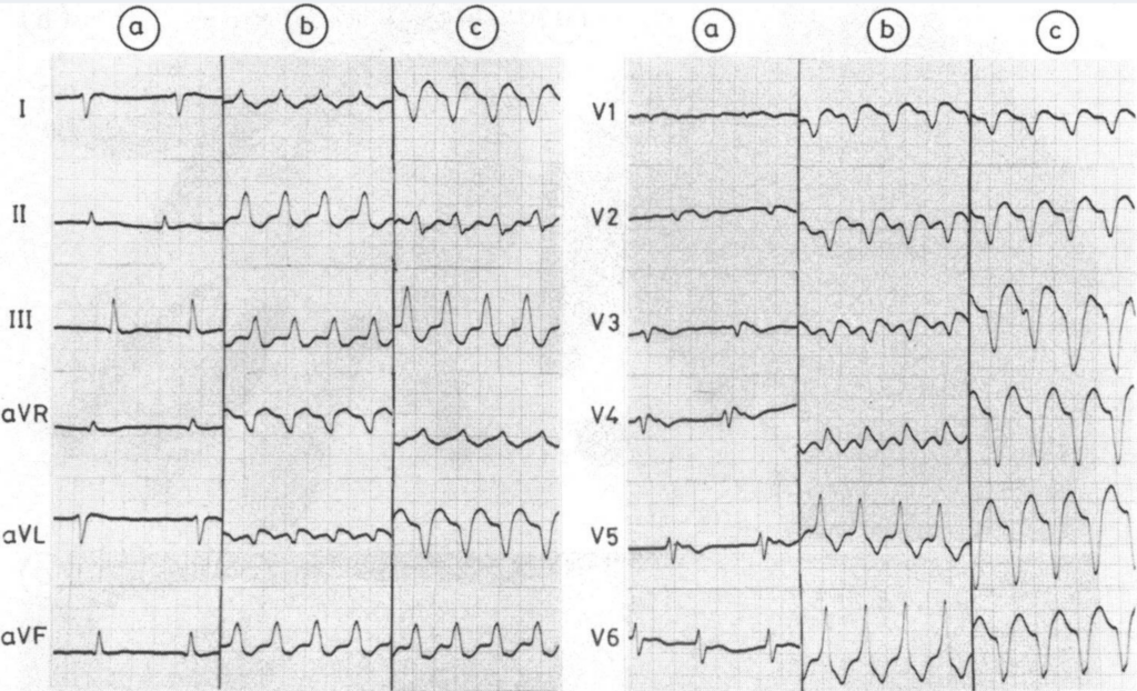 Naxos disease 1986 ECG