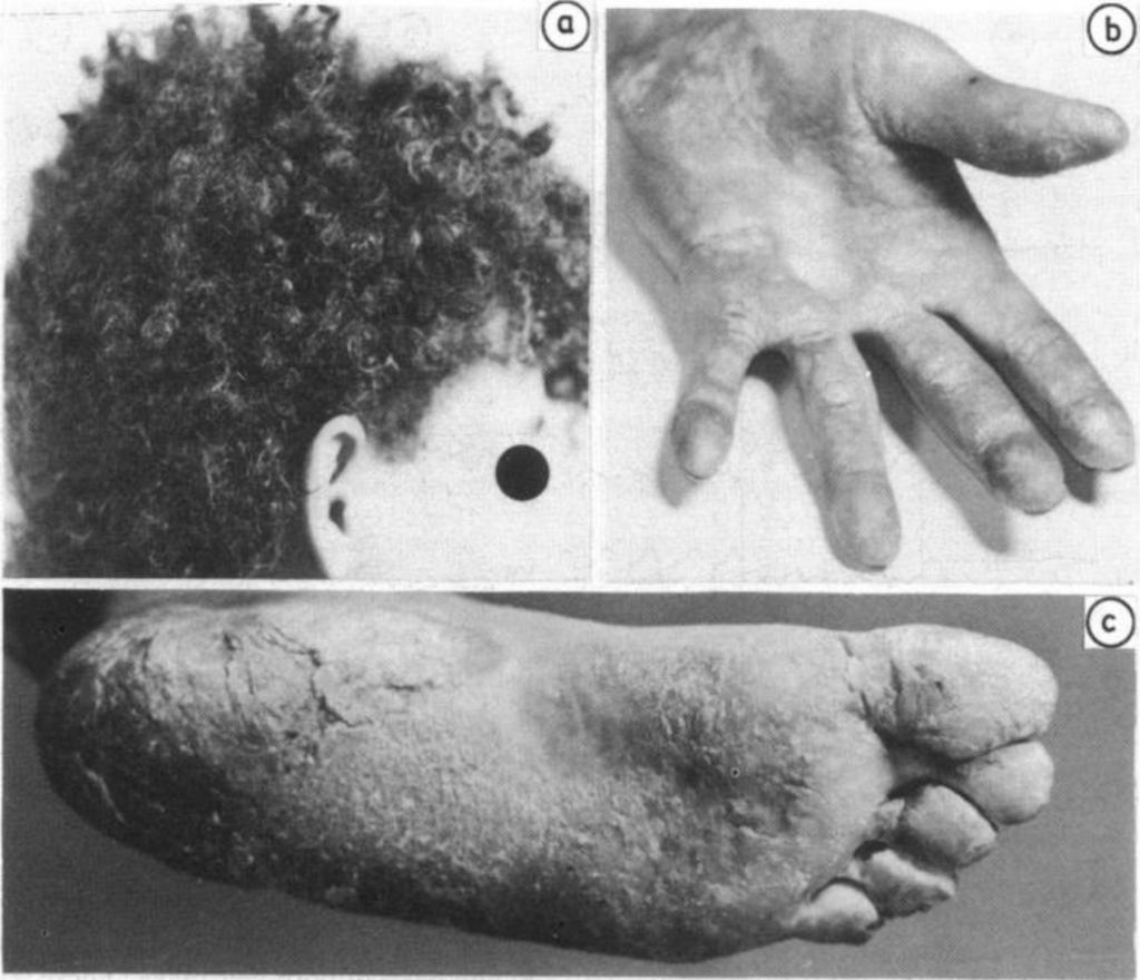 Naxos disease 1986 images