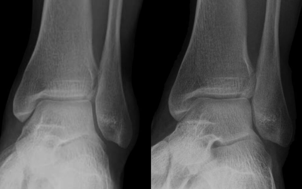 Adult Tillaux fracture Case 12