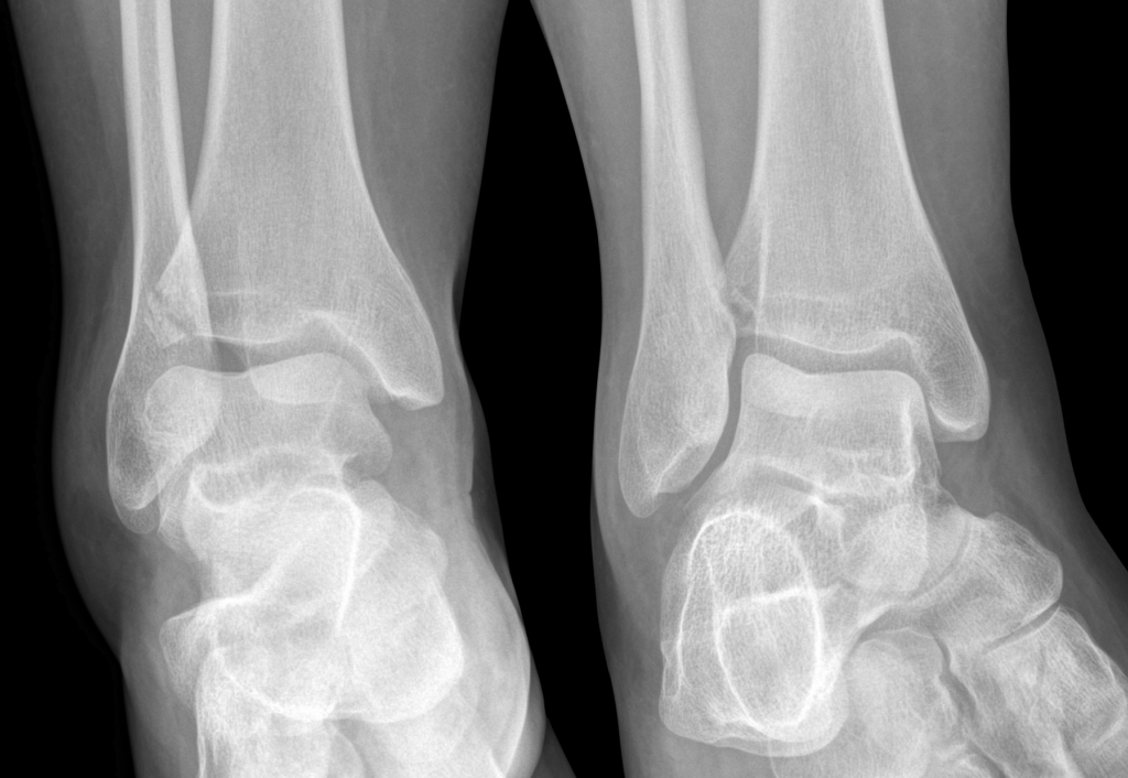 Adult Tillaux fracture Case 2