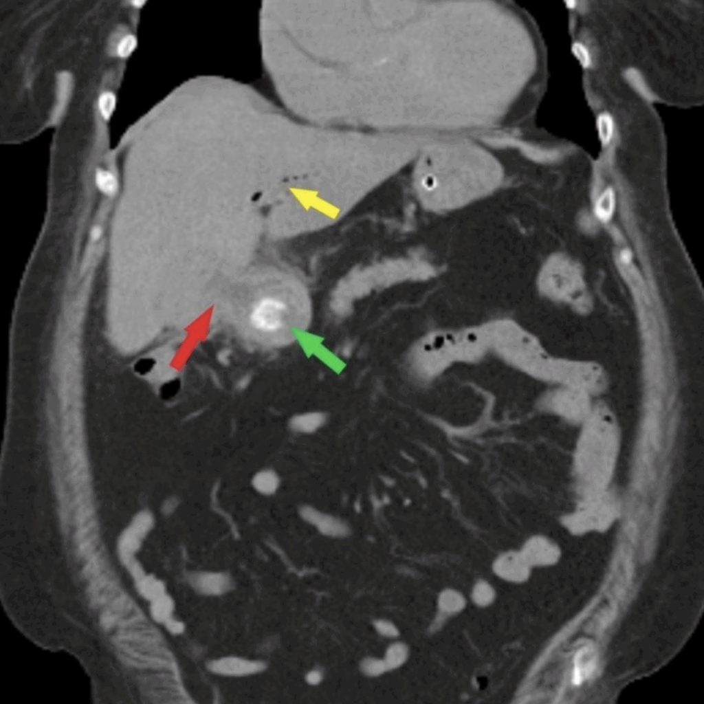 Case 1 CT Bouveret Syndrome
