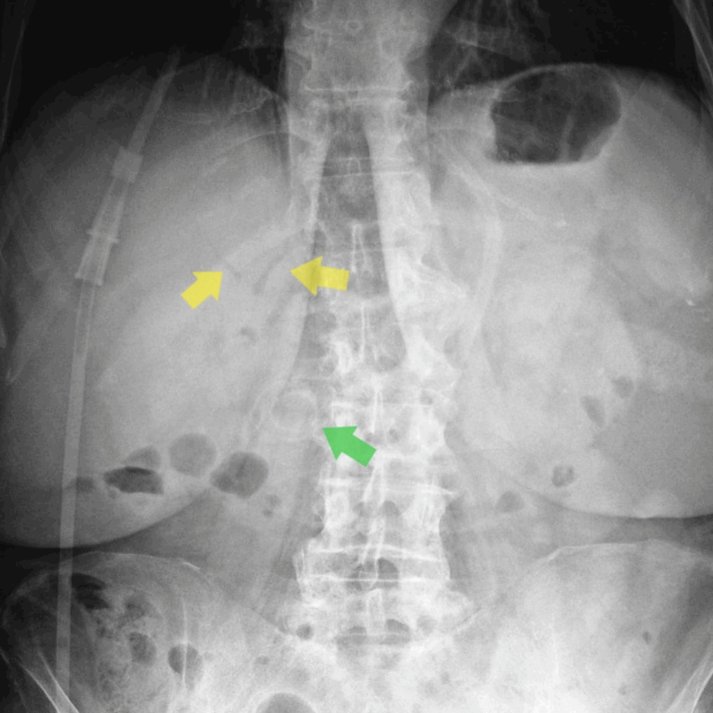 Case 1 XR Bouveret Syndrome