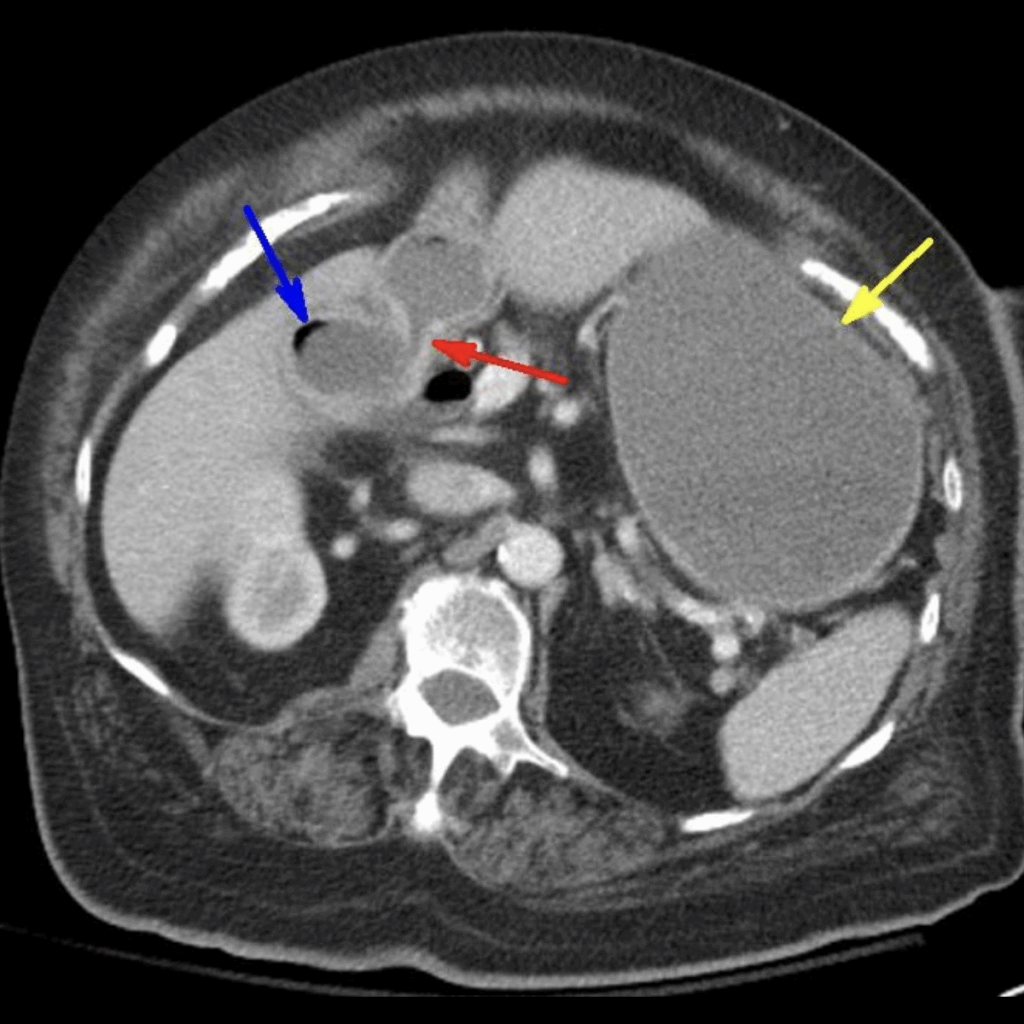 Case 2 CT Bouveret Syndrome