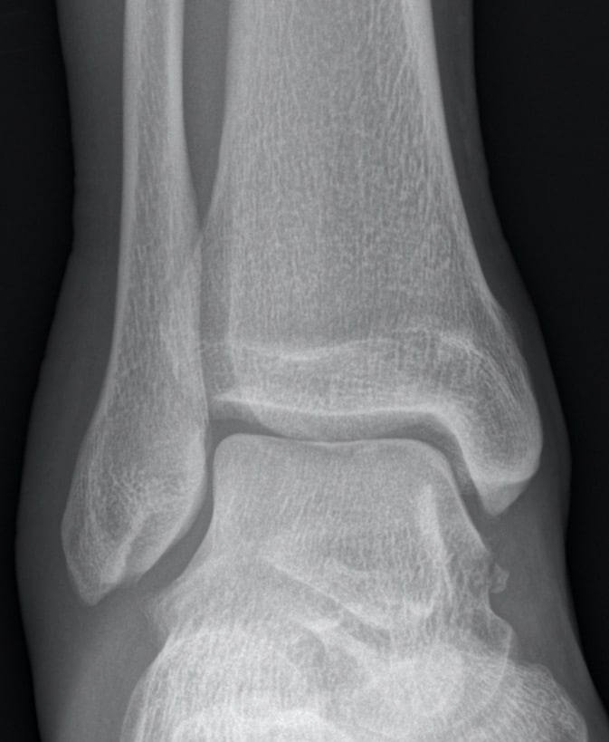 talus fracture mri