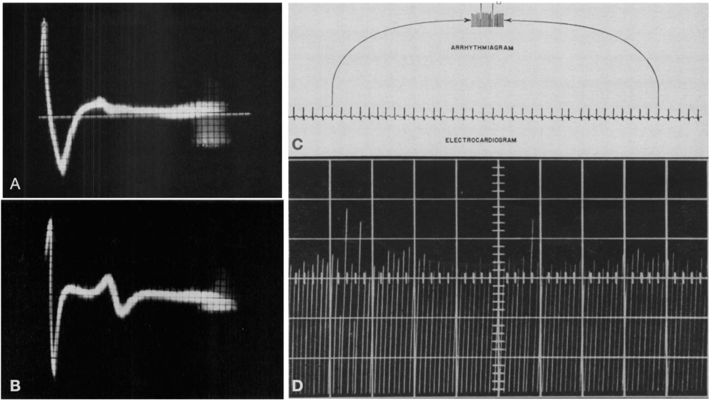 Holter AVSEP and arrhythmiagraph 1961