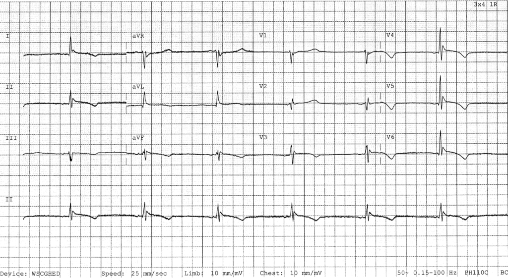 Osborn wave temp 26 example 4