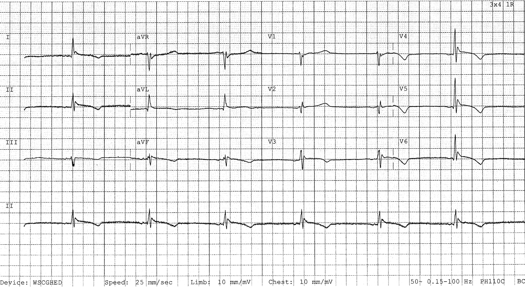 Johnson Waveforms Osborn Wave (J Wave) • LITFL • ECG Library Basics