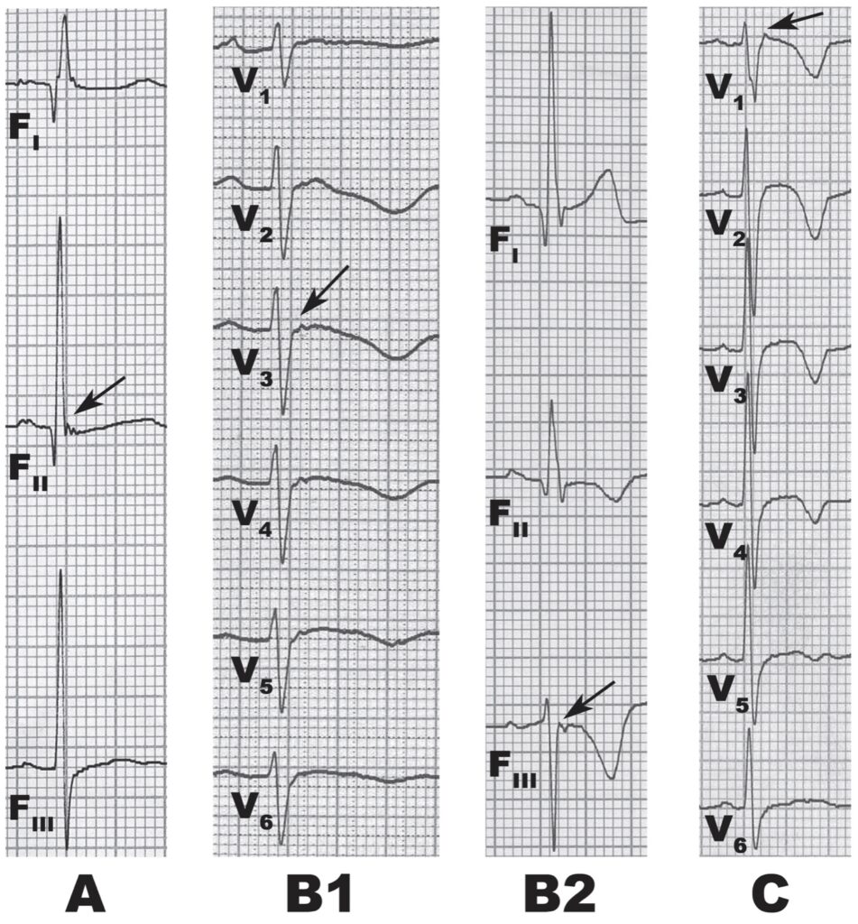 Patterns of epsilon waves wang et al 2010