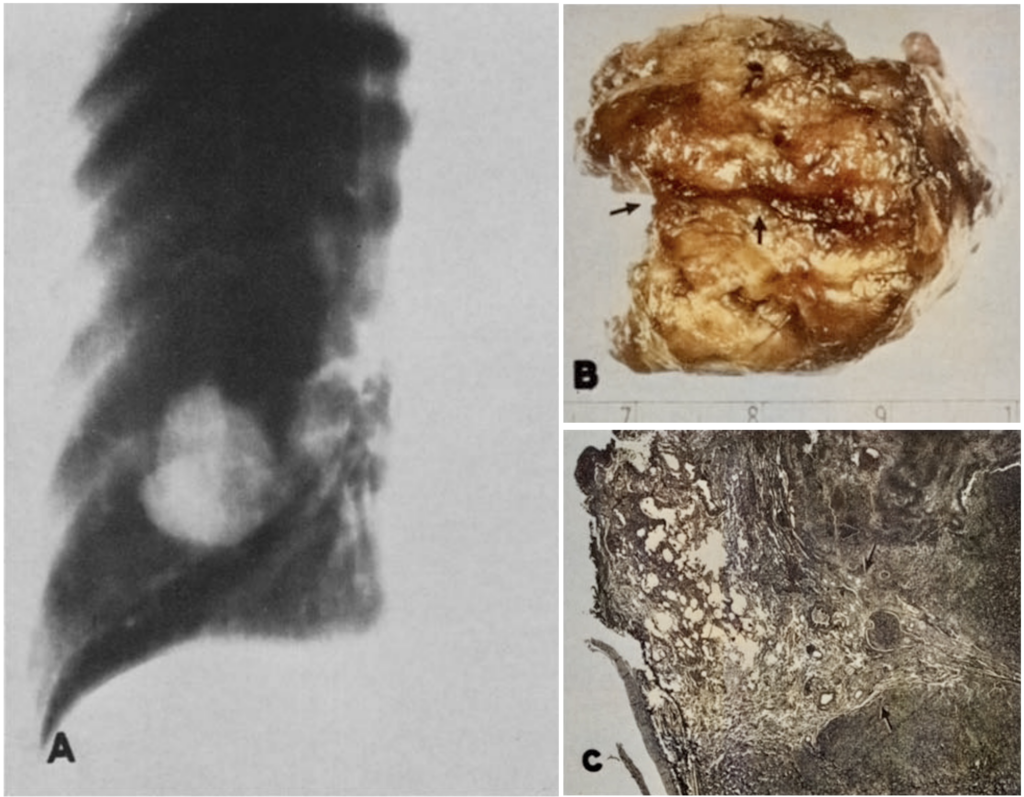 Rigler notch sign pathology and histology