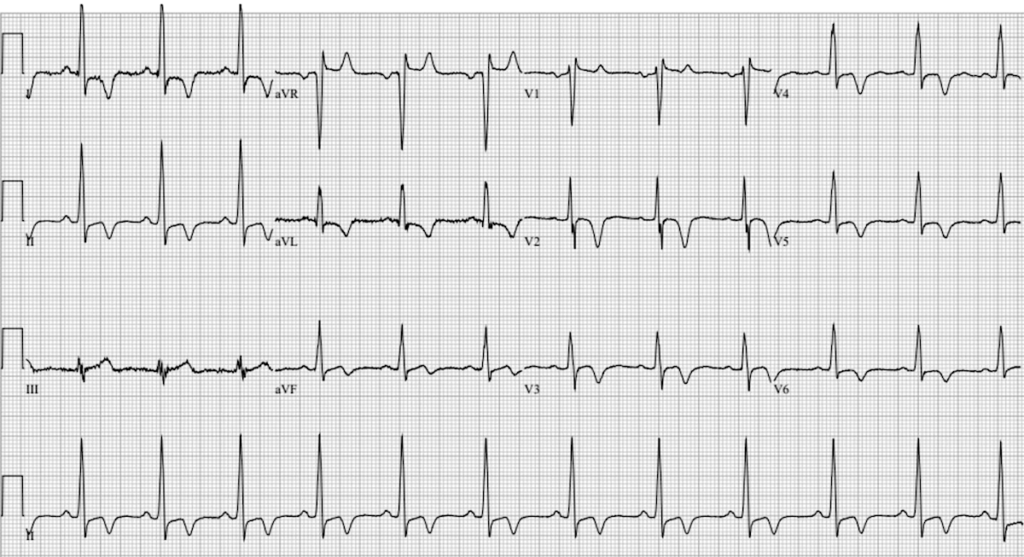 Apical hypertrophic cardiomyopathy (AHC) Yamaguchi syndrome