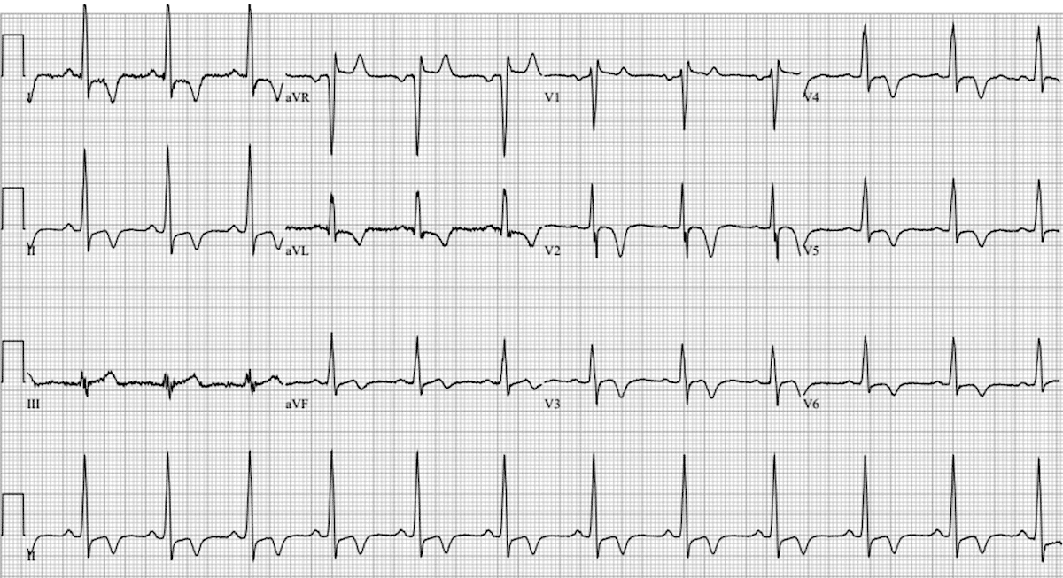 Apical hypertrophic cardiomyopathy (AHC) • LITFL • ECG Library