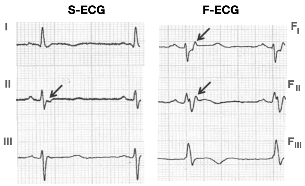 Fontaine leads showing epsilon waves in ARVD C 2019