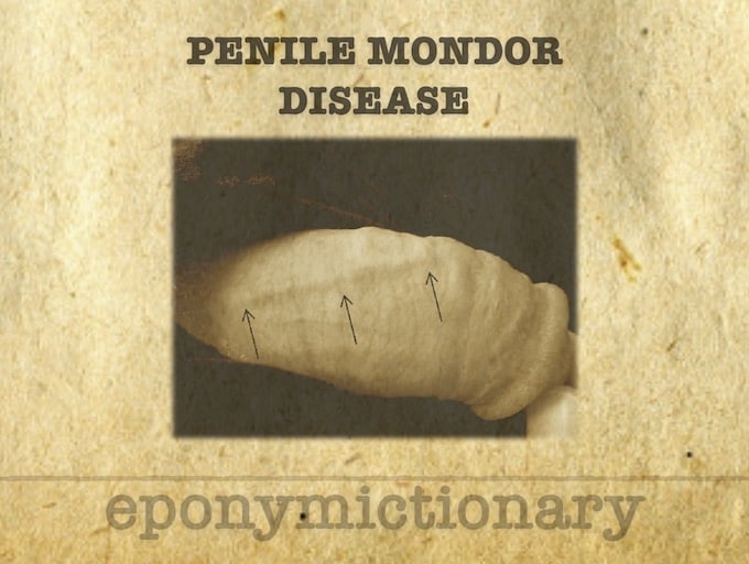 Penile Mondor's disease 680