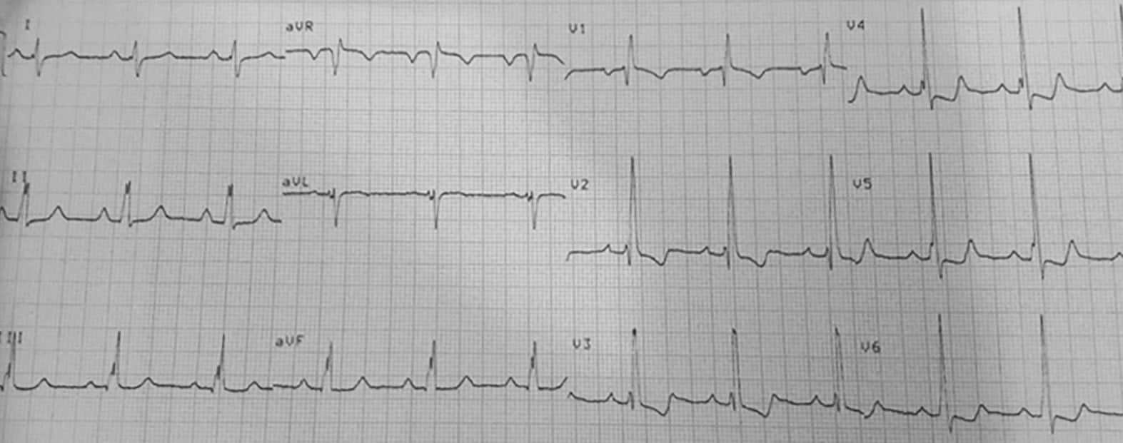 What is crochetage sign in atrial septal defect? 