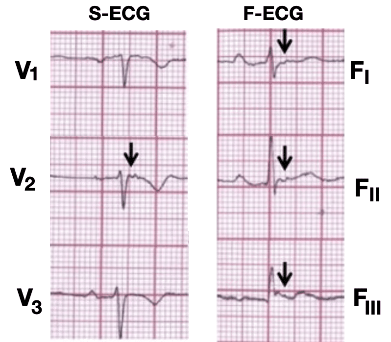 ECG Rate Interpretation • LITFL Medical Blog • ECG Library Basics