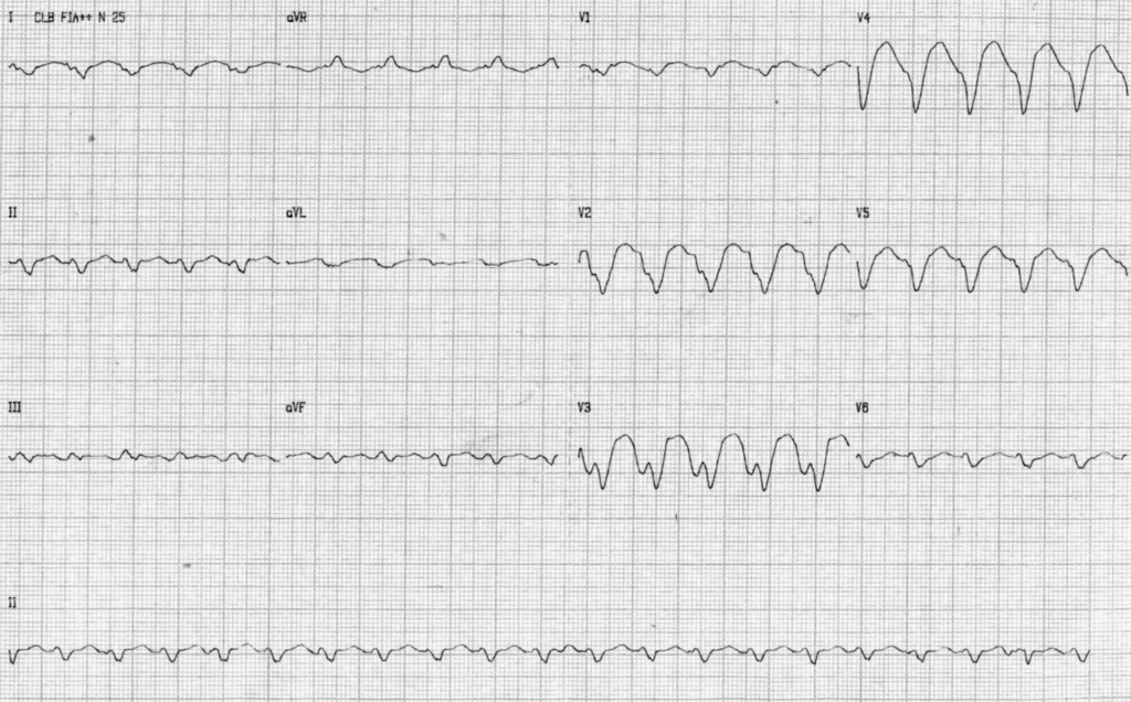 sustained VT with LBBB pattern 1