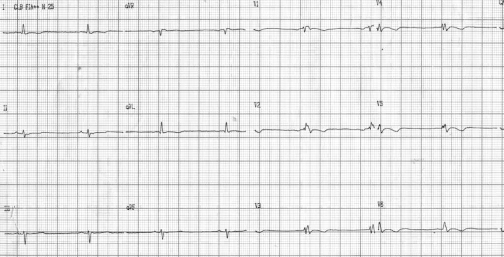 sustained VT with LBBB pattern post cardioversion 2