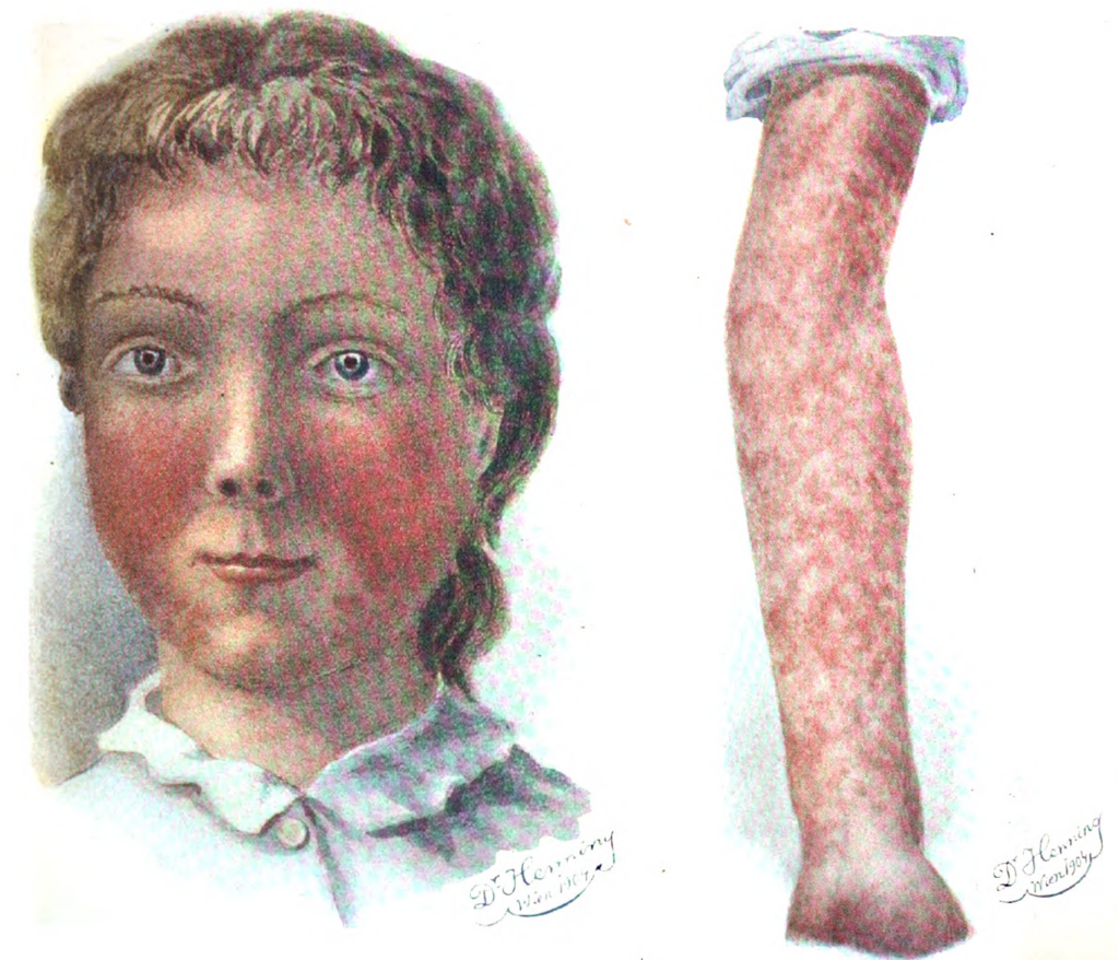 dukes disease