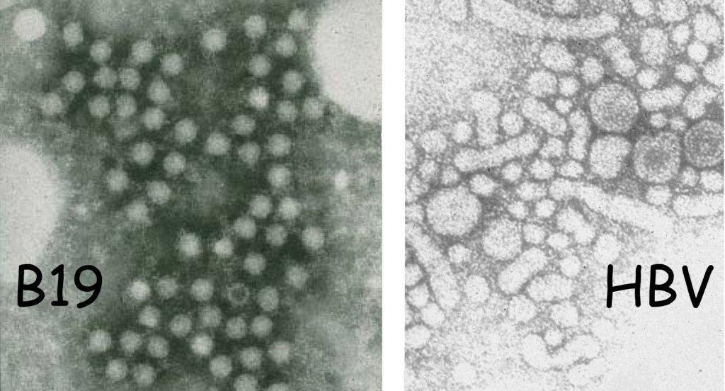 Cossart 2013 Parvovirus B19 versus hepatitis