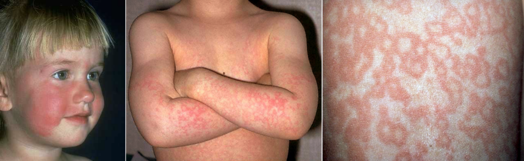 Erythema infectiosum (fifth disease) 2