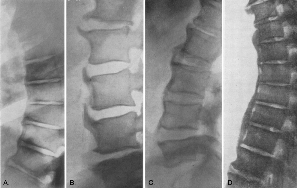 1950 Forestier Senile ankylosing hyperostosis of the spine