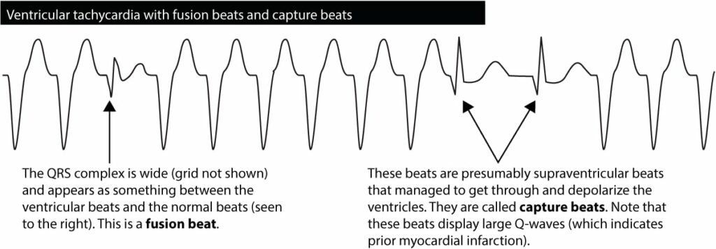 Capture Beat Fusion Beat VT ECG waves