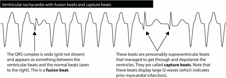 VT versus SVT • LITFL Medical Blog • ECG Library Basics