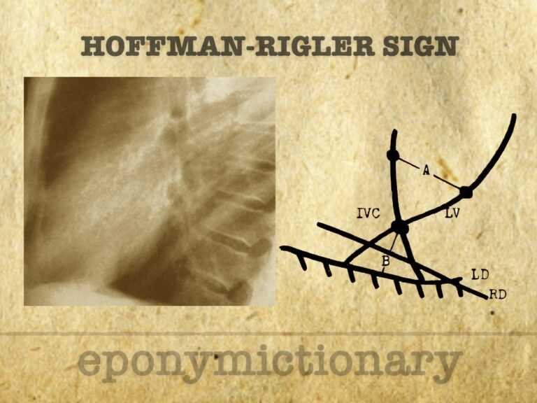 Hoffman-Rigler sign 680