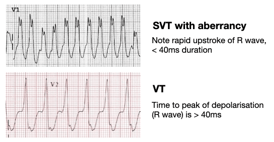 VT versus SVT: It's as easy as ABCDE • LITFL • ECG Library