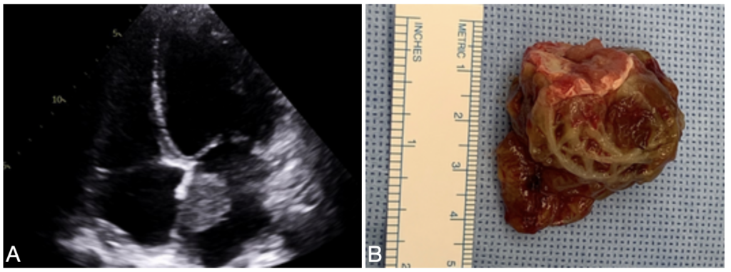 Left atrial myxoma pathology and echo 2