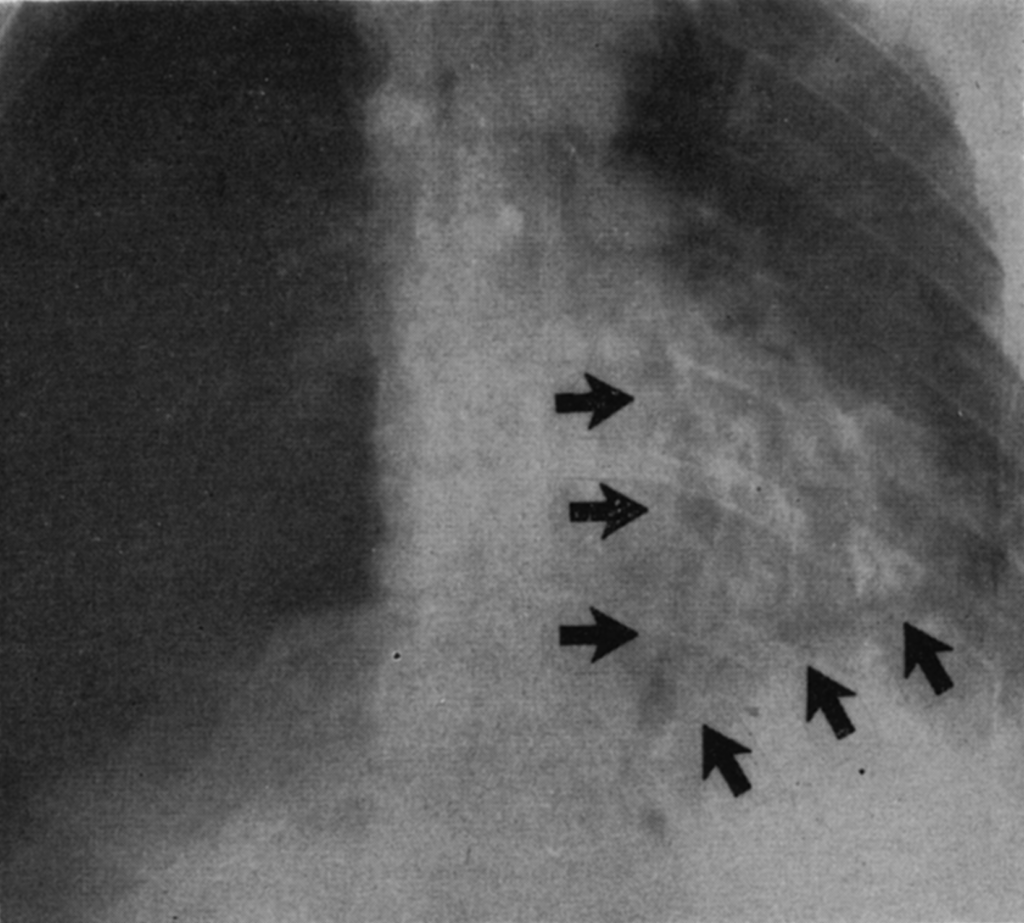 Naclerio 1957 The V sign in the diagnosis of spontaneous rupture of the esophagus