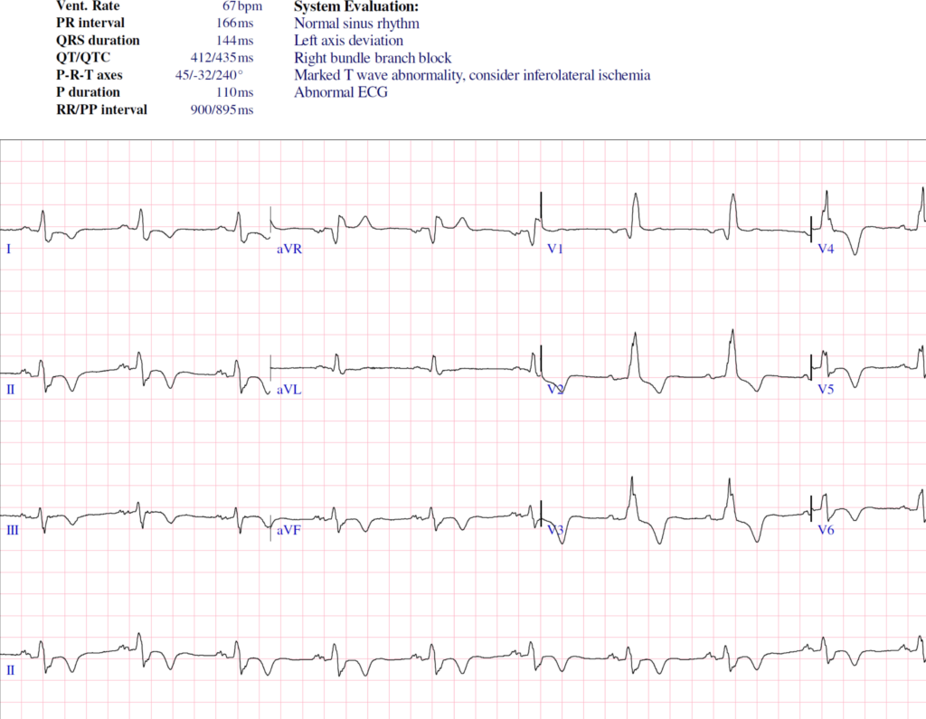 Hypertrophic Cardiomyopathy (HCM) HeartHQ