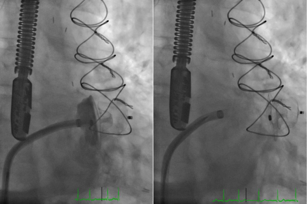 Left Atrial Appendage (LAA) Closure Procedure