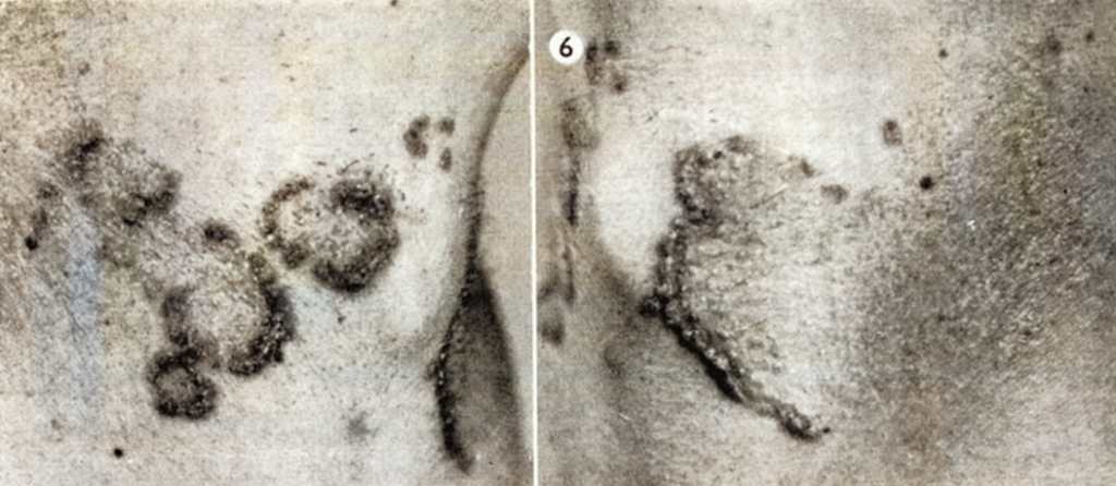 Lutz-Miescher syndrome (1953)