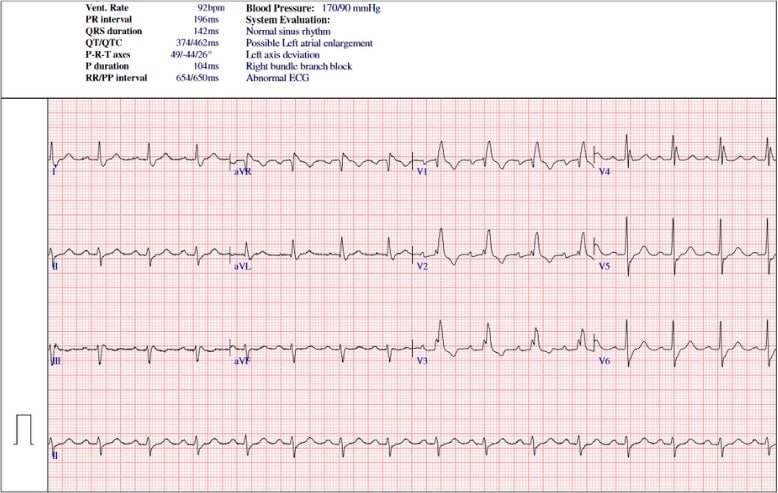 Right Bundle Branch Block Heart