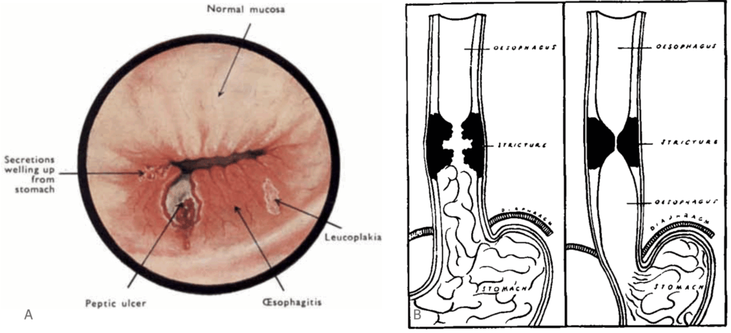 Barrett's oesophagus 1950
