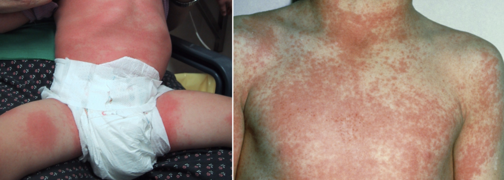 Scarlet fever rash 2