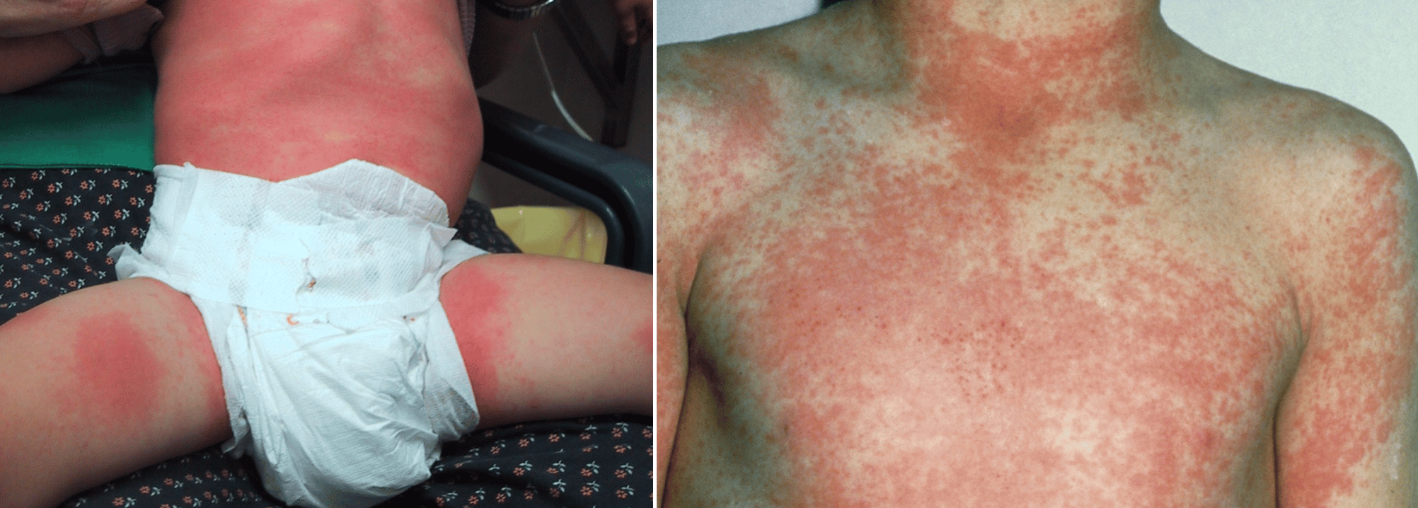 streptococcal pharyngitis rash