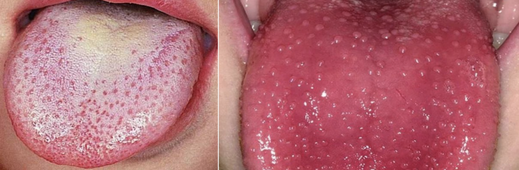 Scarlet fever white and red strawberry tongue