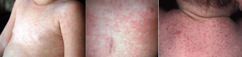 roseola infantum sixth disease Exanthem subitum