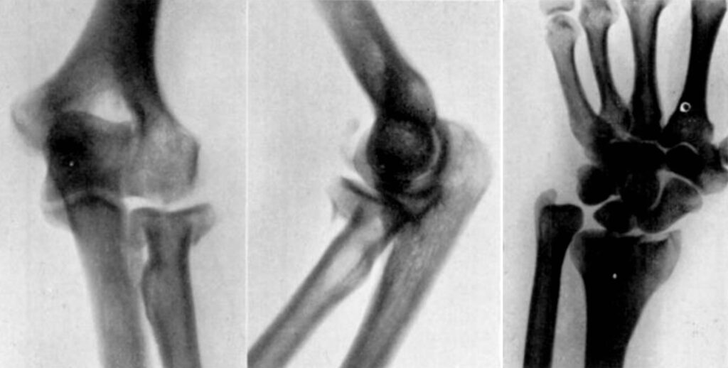 Essex-Lopresti fracture 1951