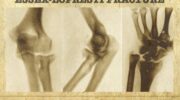 Essex-Lopresti fracture 680