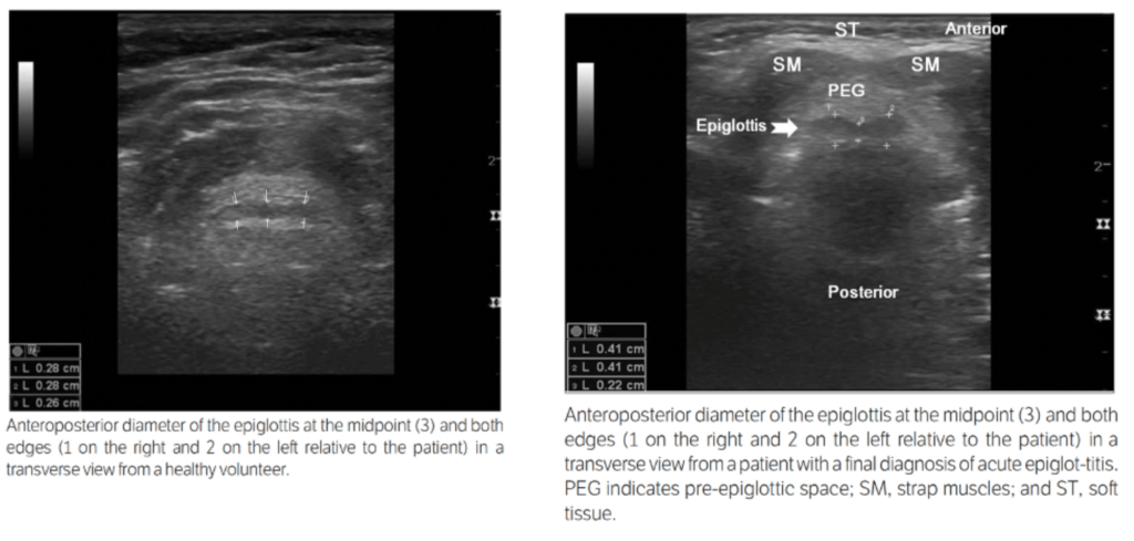 Ultrasound in the evaluation of epiglottis - Ko 2012