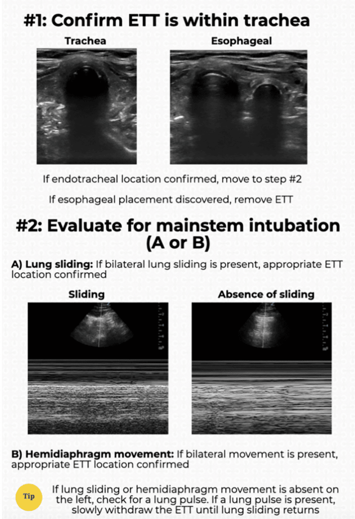 Using ultrasound to confirm ETT placement and depth - Gottlieb