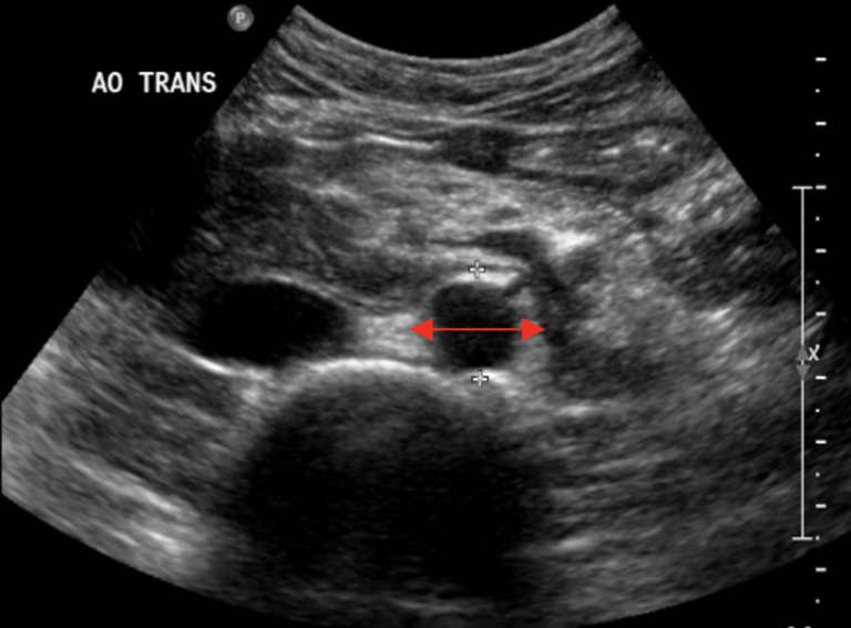 pocus-made-easy-aaa-litfl-ultrasound-library